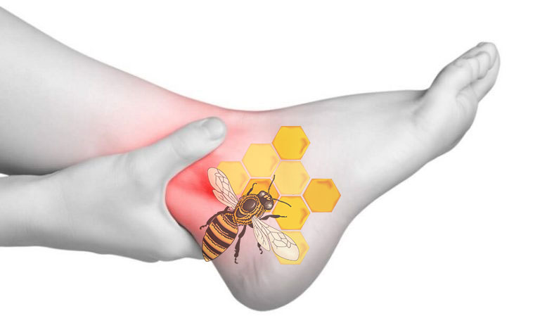 Лечение подагры пчёлами при апитерапии
